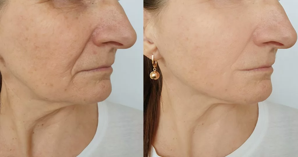 Dermal filler injections melbourne