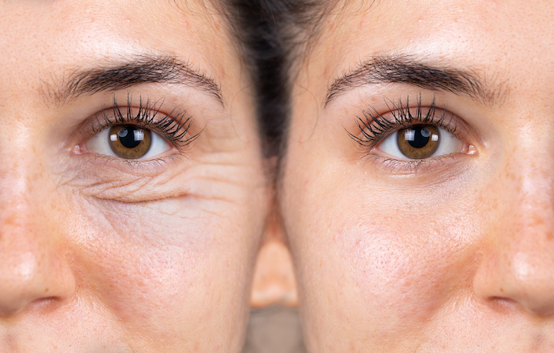 Laser Skin Rejuvenation